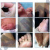 Powder Against Fungal Feet Fungal Infections